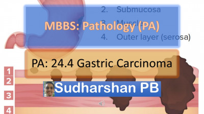 PA 24.4 Gastric carcinoma