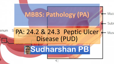 PA 24.2 & 24.3 Peptic ulcer disease