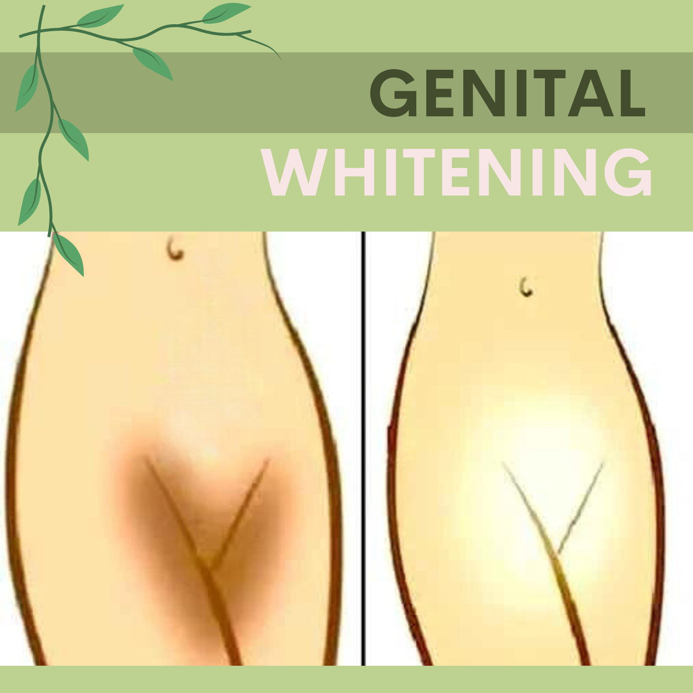 Vaginal Whitening Treatment, Genital Whitening Surgery Cost in Surat, Gujarat, Mumbai, Pune, India episode artwork
