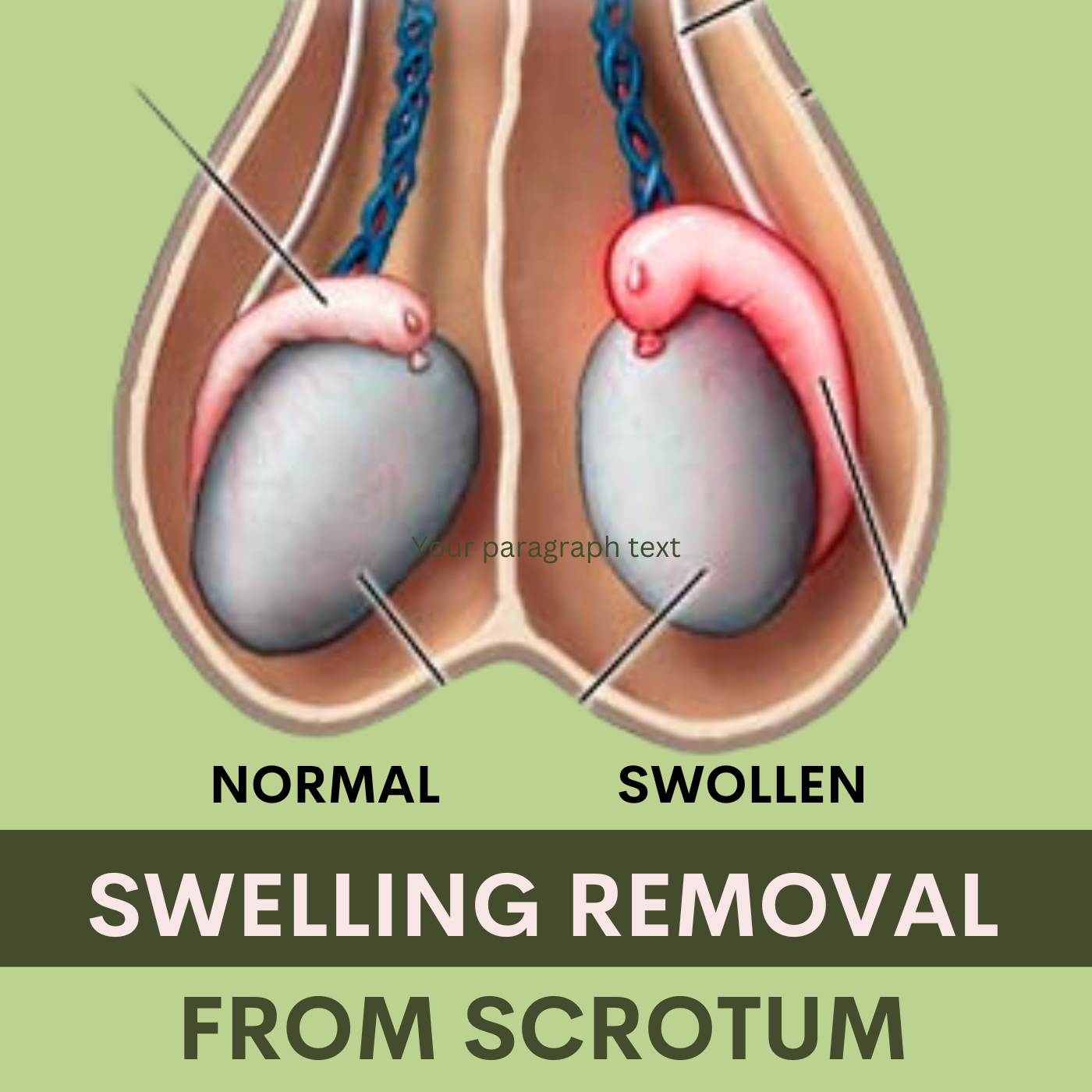 Swelling Removal From Scrotum, स्क्रोटल सूजन, फोड़े फुंसी का इलाज, Surat, Ahmadabad, Anand, Mumbai episode artwork