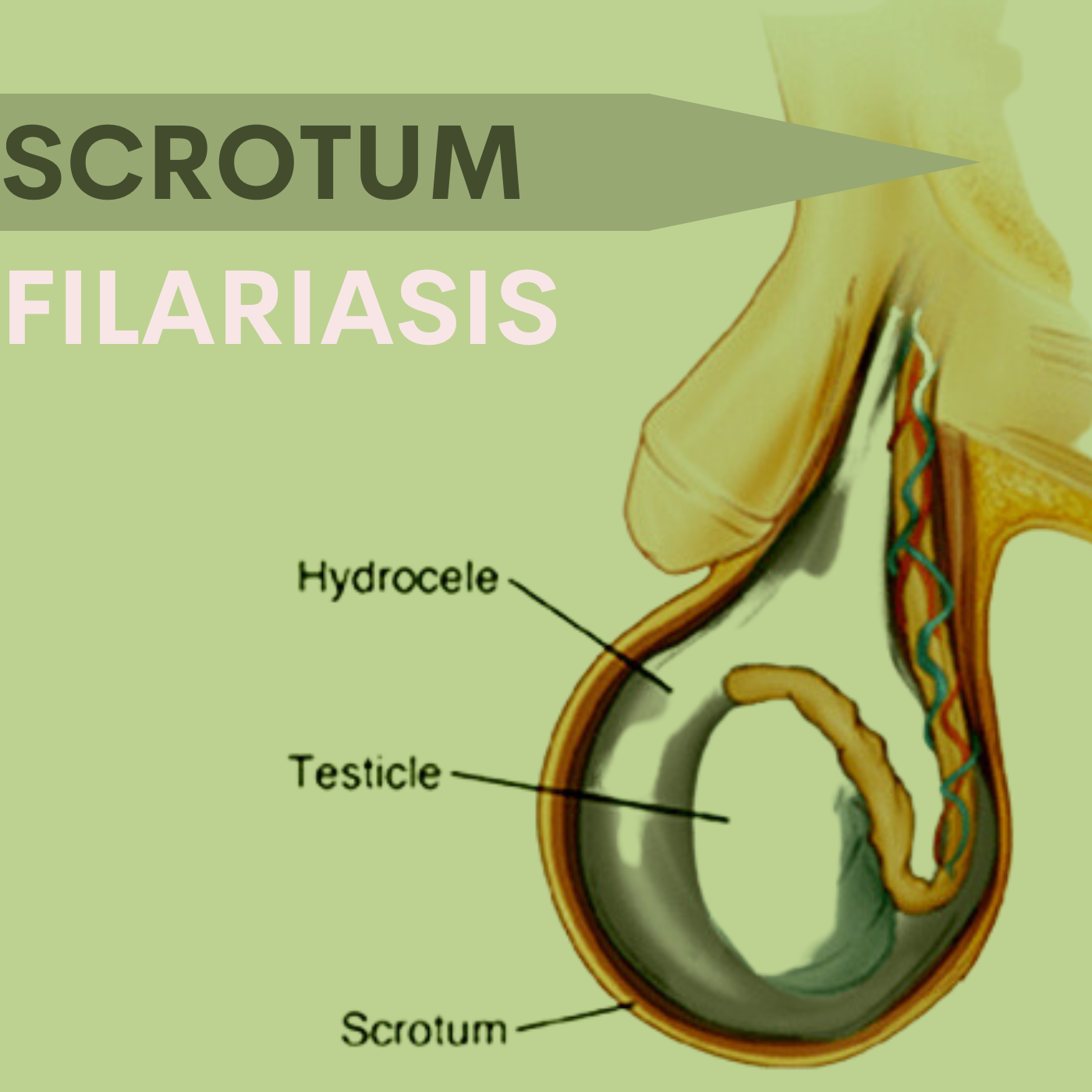 Scrotum Filariasis, Elephant Foot Treatment, Swollen Leg, Giant Leg Treatment, Surat, Gujarat, India episode artwork