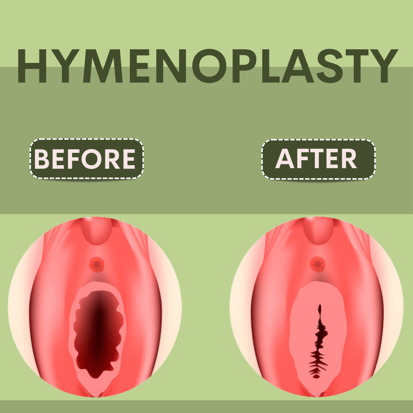 Hymenoplasty, Hymen Restoration, Hymen Repair, Restore Virginity, Surat, Anand, Gujarat, Pune, India episode artwork