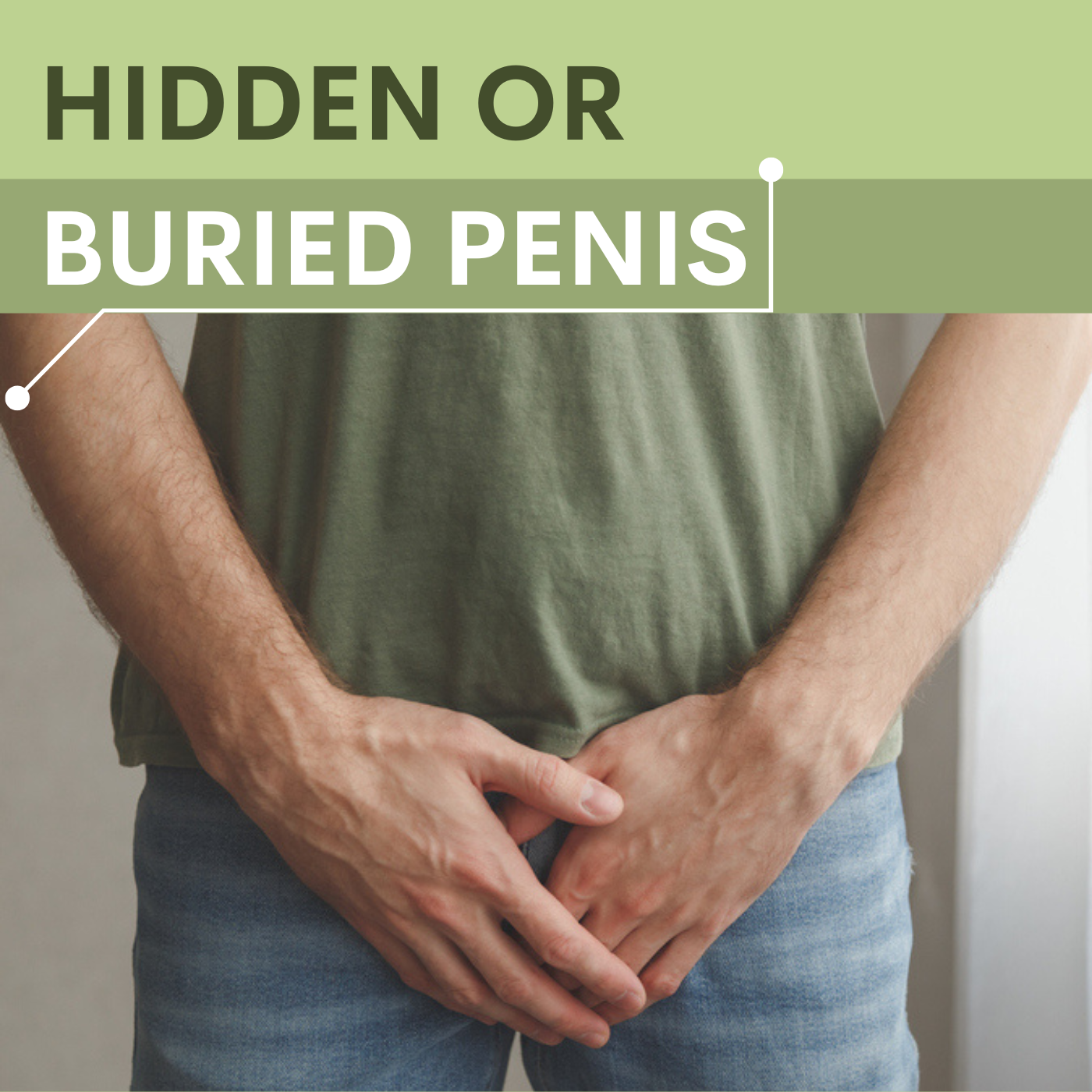 Buried Penis Or Hidden Penis, Small Penis Treatment at Low Cost In Surat, Gujarat, Mumbai, Pune