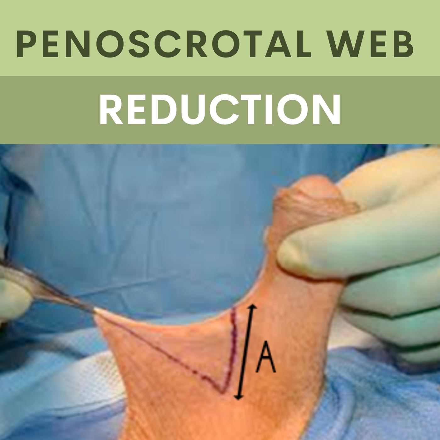 Penoscrotal Web Reduction, Scrotoplasty, Enlarged Scrotum Reduction, Surat, Gujarat, Mumbai, Pune episode artwork