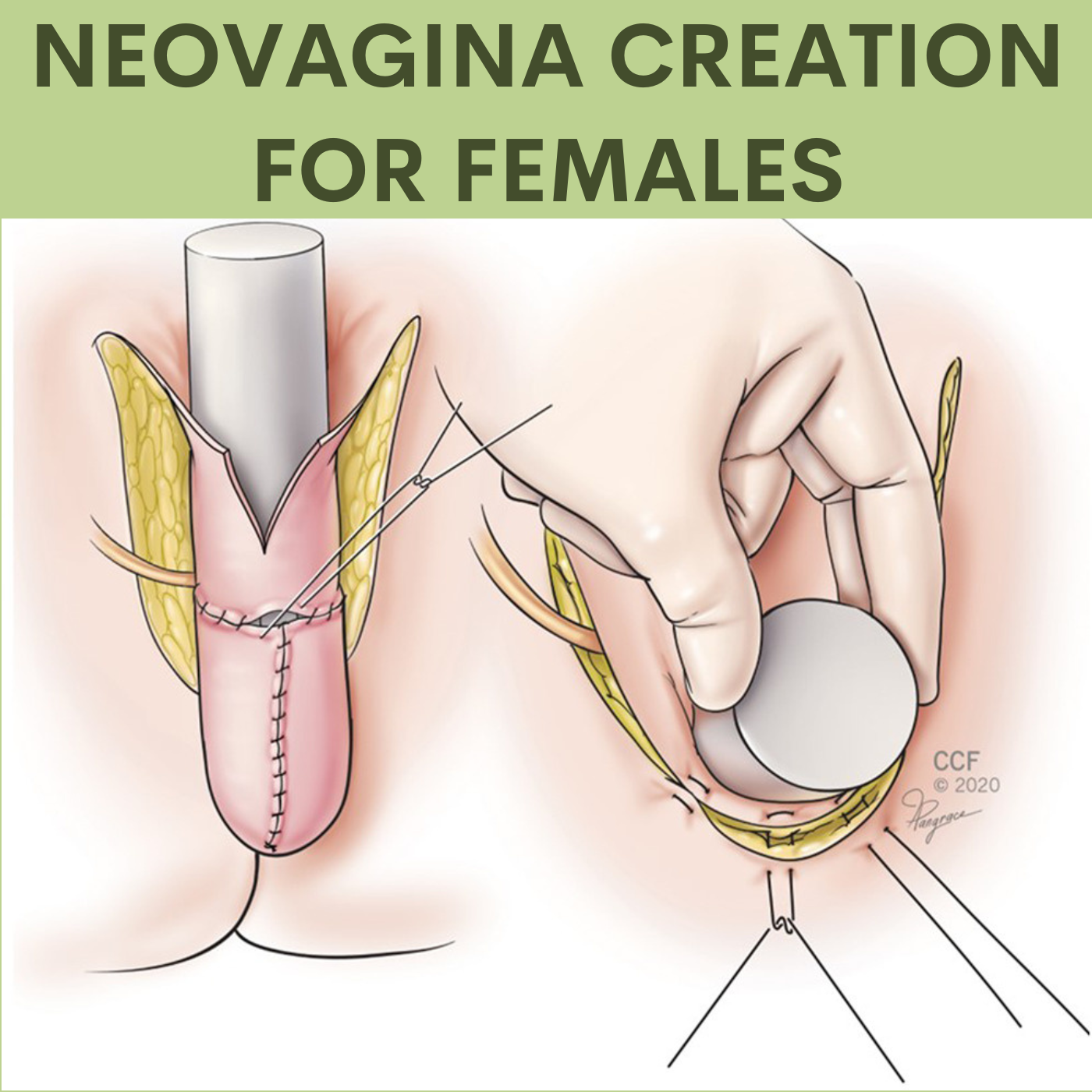 New Vagina Creation Neovagina Creation Surgery in Bharuch, Valsad, Chikhli, Surat, Mumbai, Gujarat episode artwork