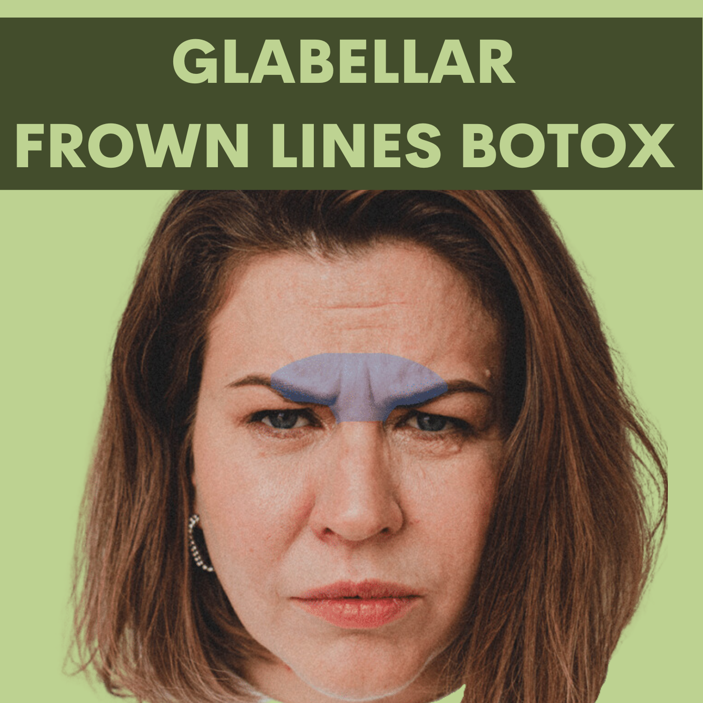 Glabellar Frown Lines Botox - Filler Treatment Surat, Vadodara, Ahmedabad, Gujarat, Mumbai