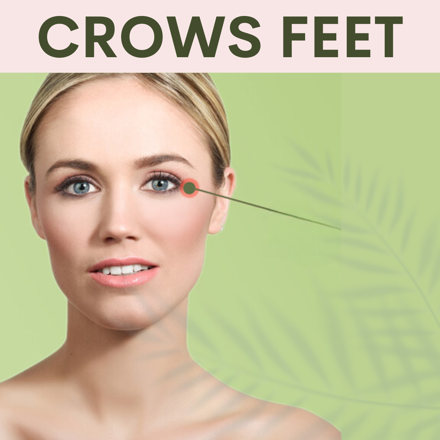 Crows Feet Correction | Botox Treatment | Surat, Ahmedabad, Gujarat, Mumbai, Pune, Maharashtra.