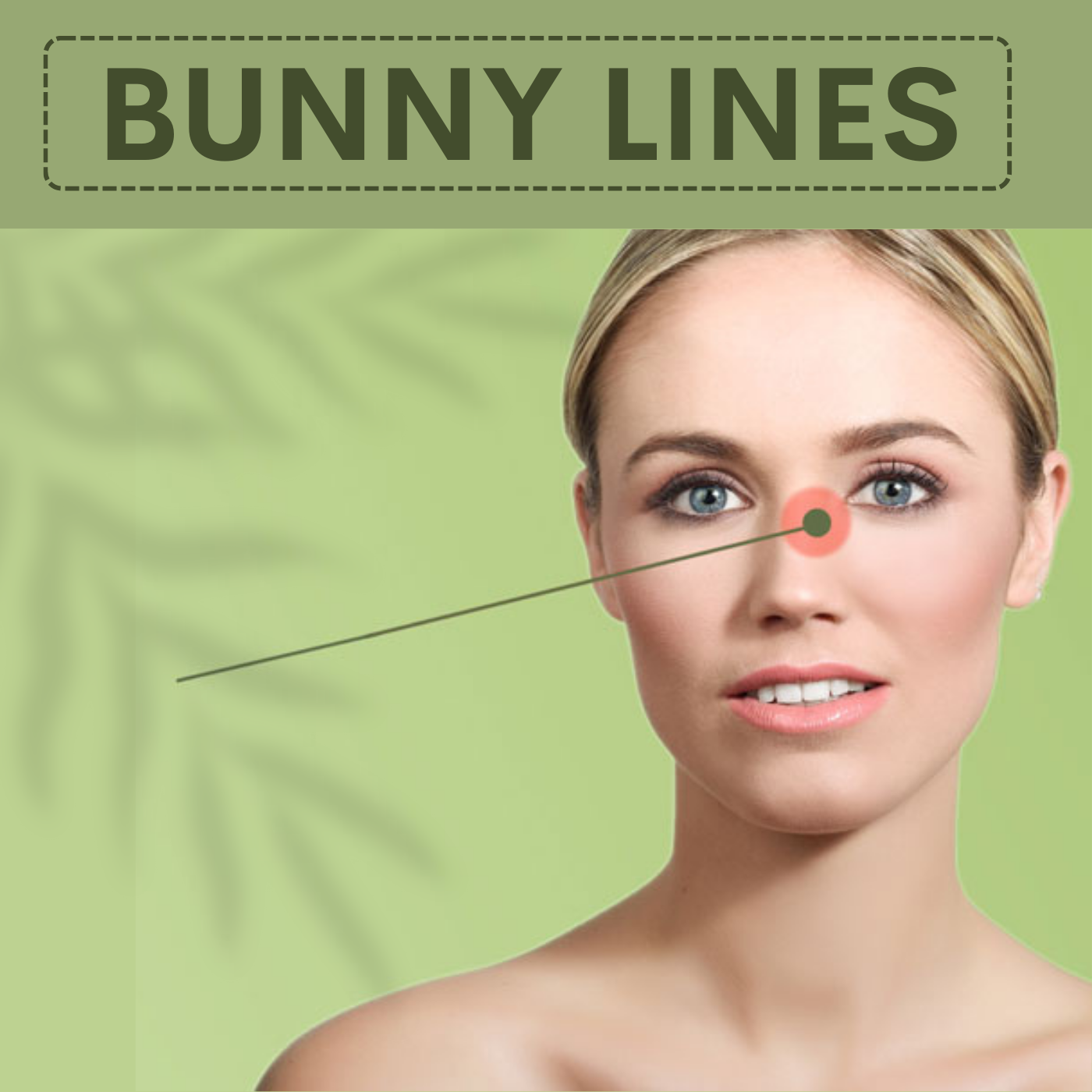 Bunny Line Correction, Botox - Filler Treatment Elegance Clinic Surat Gujarat, Mumbai Maharashtra. episode artwork
