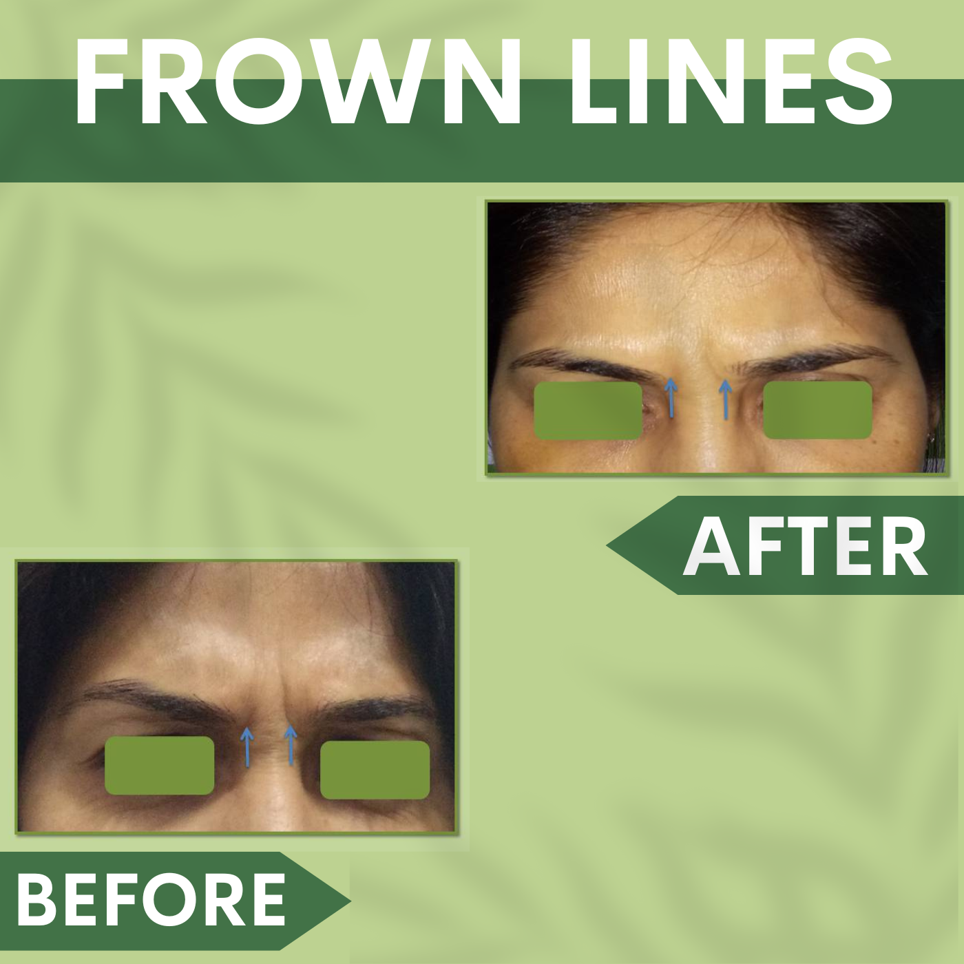 Frown Lines Correction, Frown Lines Treatment, Botox - Filler Treatment Surat, Vadodara, Gujarat. episode artwork