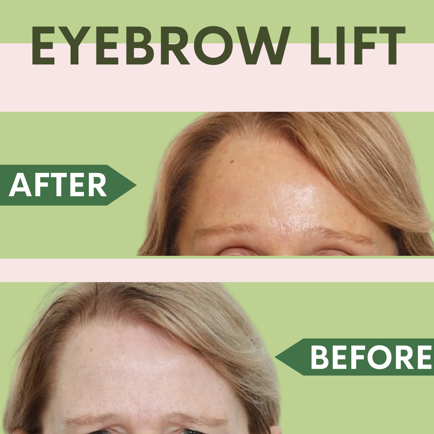 Non-Surgical Eyebrow Lift, Botox - Filler Treatment Surat, Vadodara, Gujarat, Mumbai, Maharashtra episode artwork