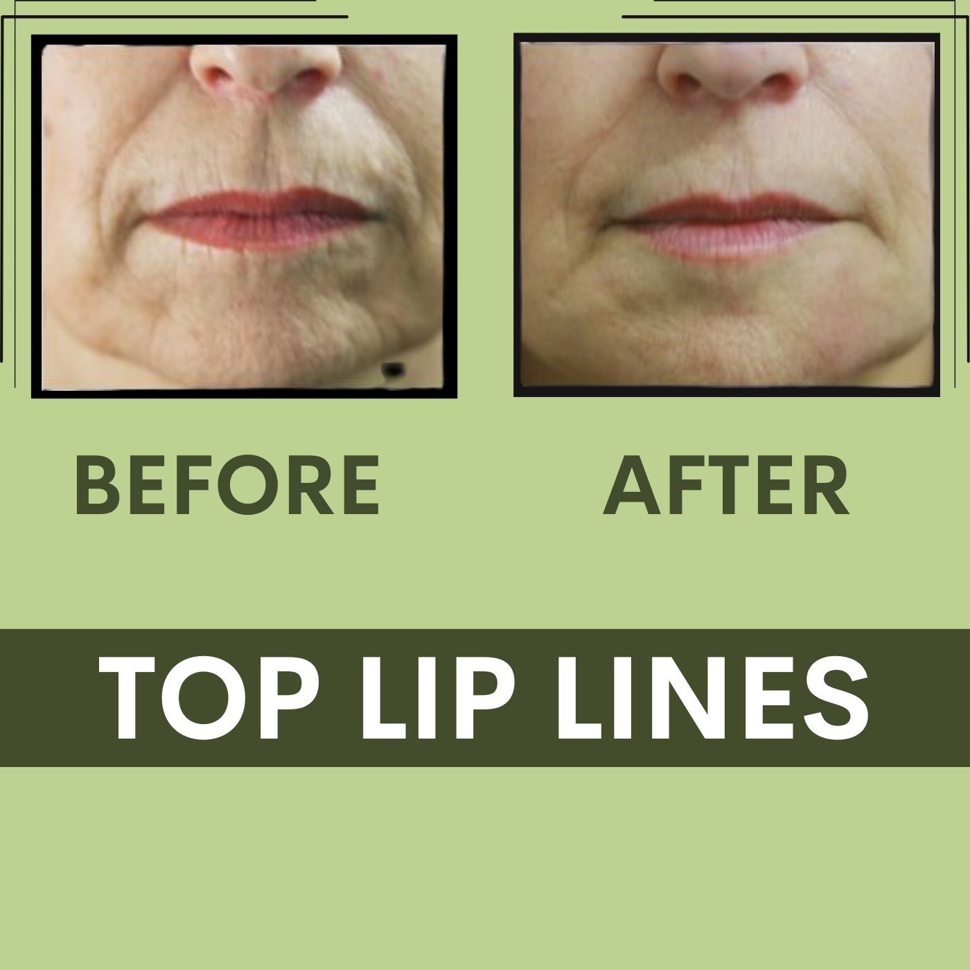 Lip Lines, Botox - Filler Treatment Surat, Vadodara, Gujarat, Mumbai, Nashik, Maharashtra, Indore. episode artwork