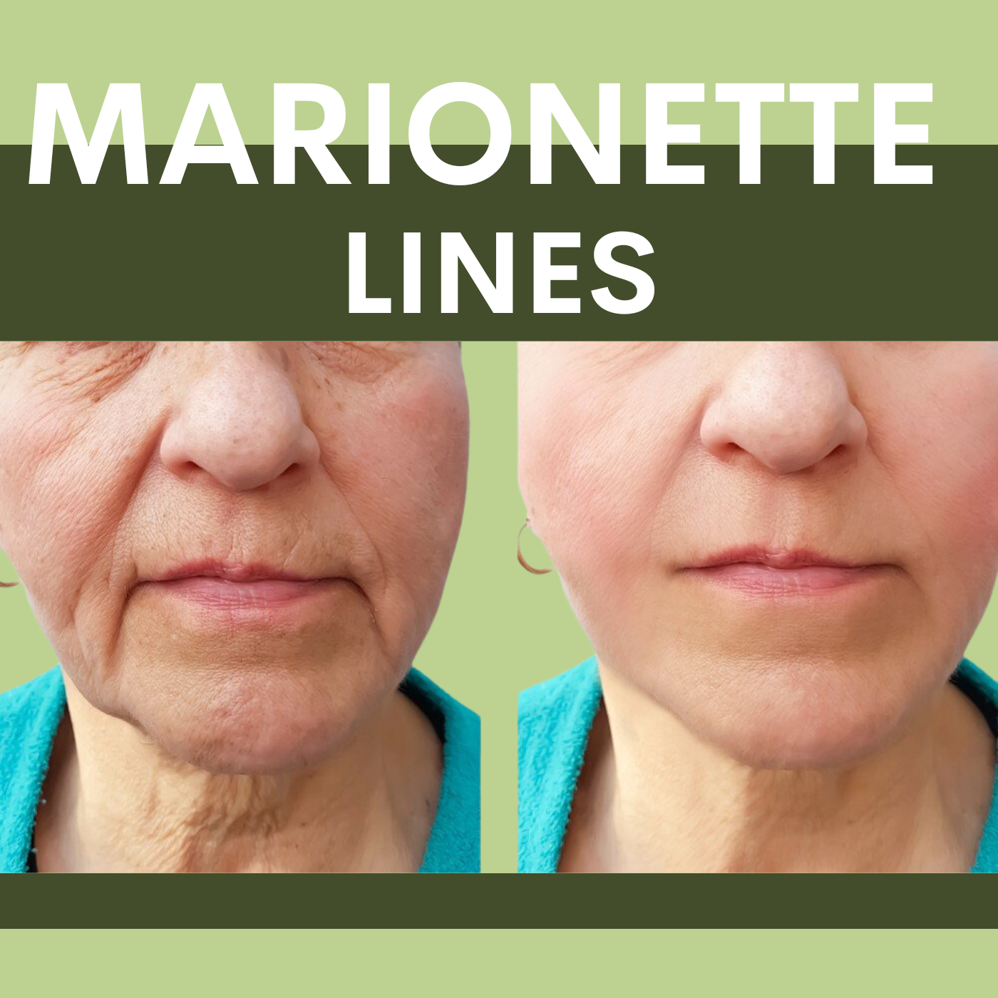 Marionette Lines, Botox - Filler Treatment Surat, Vadodara, Gujarat, Mumbai, Nashik, Maharashtra episode artwork