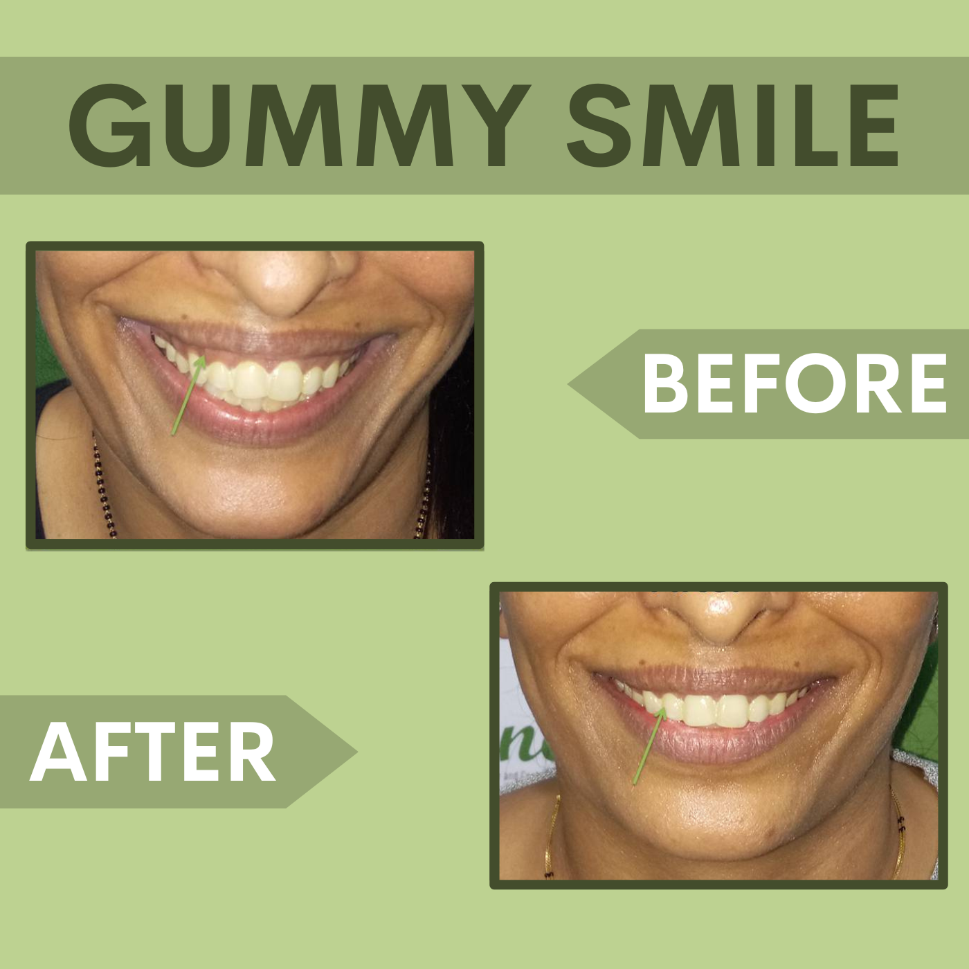 Gummy Smile Correction, Botox - Filler Treatment Elegance Clinic Surat, Gujarat, Mumbai, Maharashtra episode artwork