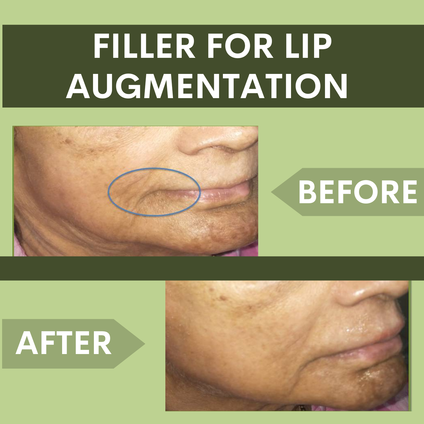 Filler for Lip Augmentation, Botox - Filler Treatment Surat, Vadodara, Ahmedabad, Gujarat, Mumbai episode artwork
