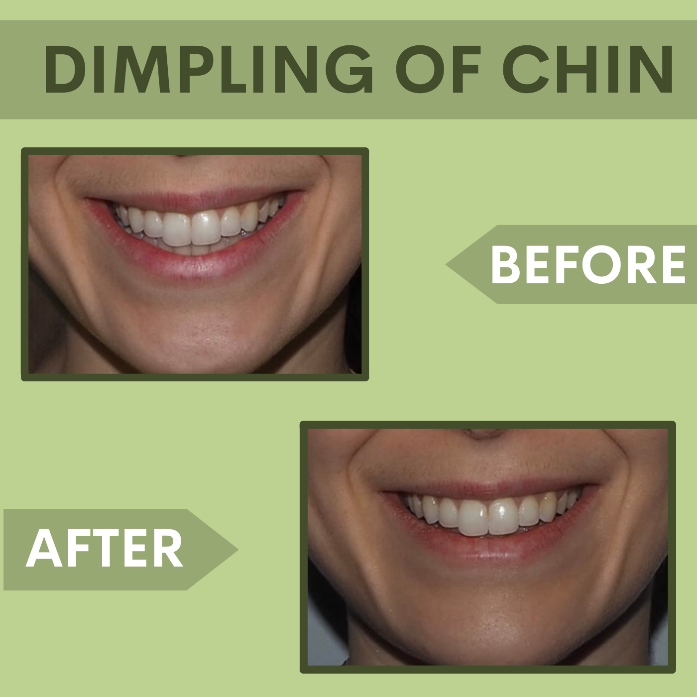 Dimpling On The Chin, Artificial Dimple, Botox Filler Treatment Surat, Vadodara, Gujarat, Mumbai, episode artwork
