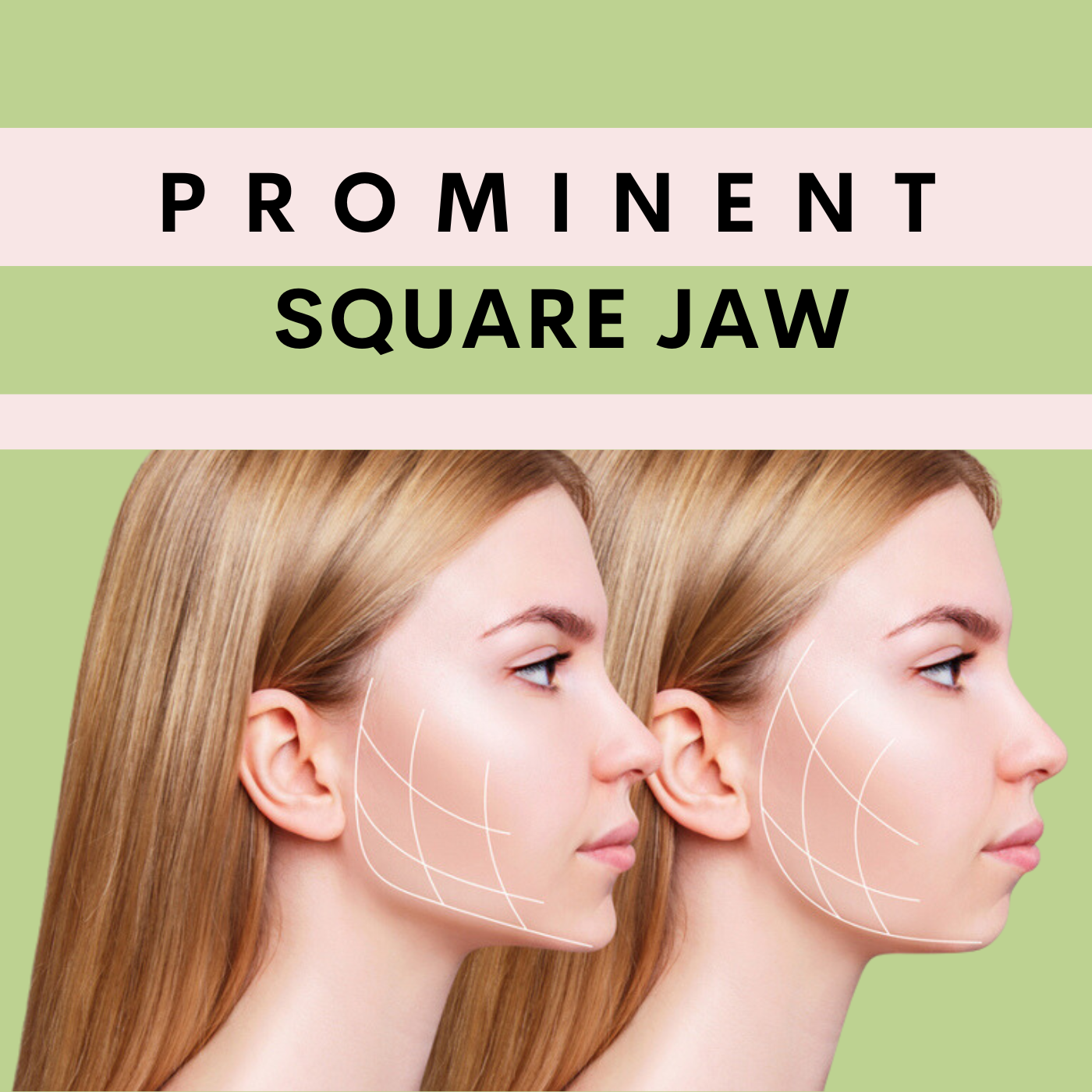 Prominent Square Jaw, Botox - Filler Treatment Surat, Vadodara, Gujarat, Mumbai, Maharashtra episode artwork