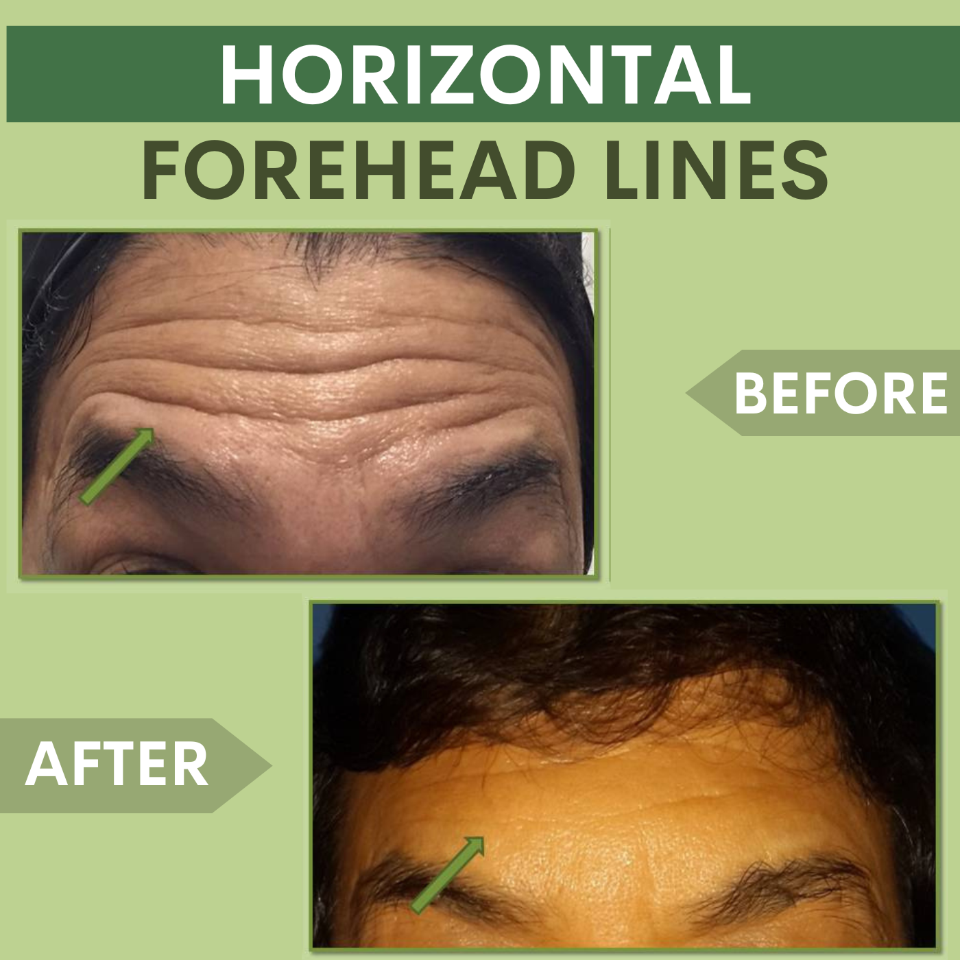 Horizontal Forehead Lines Removal Treatment , Botox - Filler Treatment Elegance Clinic Surat Gujarat episode artwork