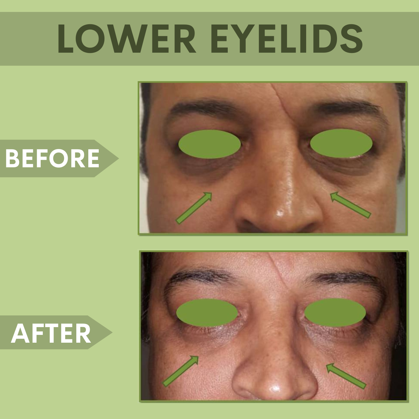 Lower Eyelid Botox Treatment, Botox and Filler Treatments Surat, Gujarat, Mumbai, Pune, Maharashtra episode artwork