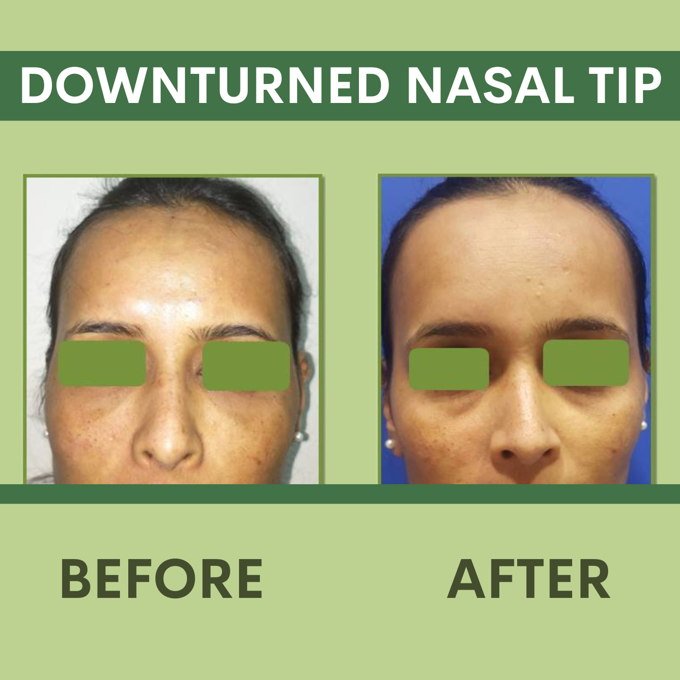 Downturned Nasal Tip Correction, Botox Treatment Elegance Clinic Surat, Gujarat, Mumbai, Maharashtra episode artwork