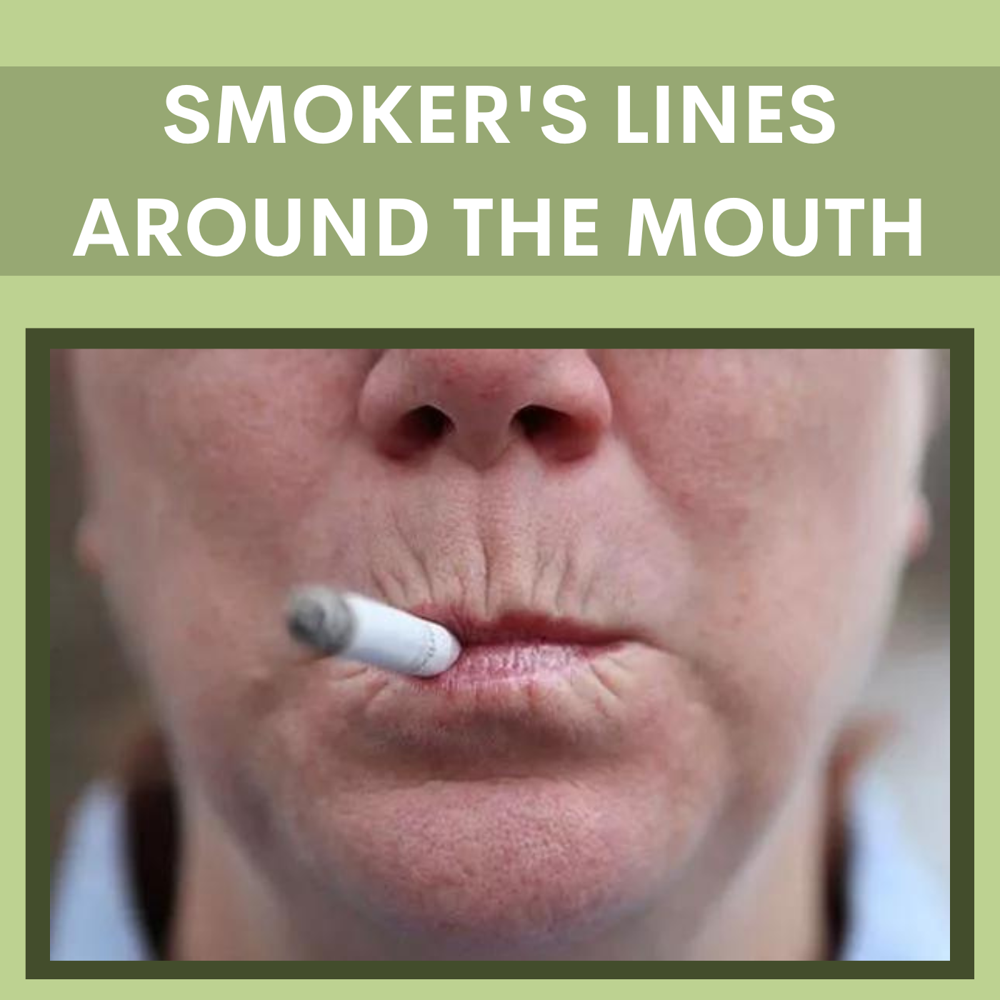 Smokers Lines Correction, Botox and Filler Treatments Clinic Surat, Gujarat, Mumbai, Maharashtra episode artwork