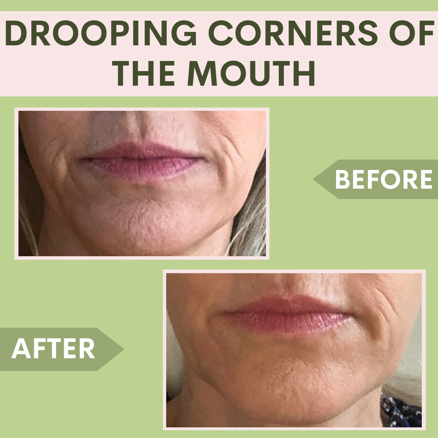 Drooping Corners Of The Mouth, Botox - Filler Treatment Surat, Vadodara, Ahmedabad, Gujarat, Mumbai episode artwork
