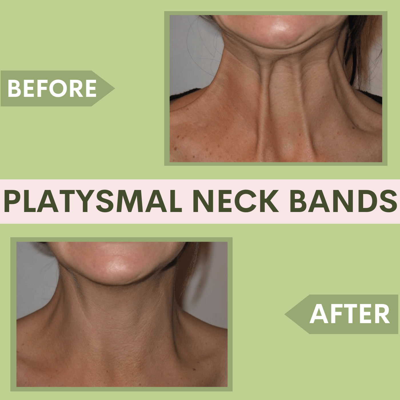 Platysmal Neck Bands, Botox Filler Treatment Surat, Vadodara, Gujarat, Mumbai, Maharashtra, Indore episode artwork