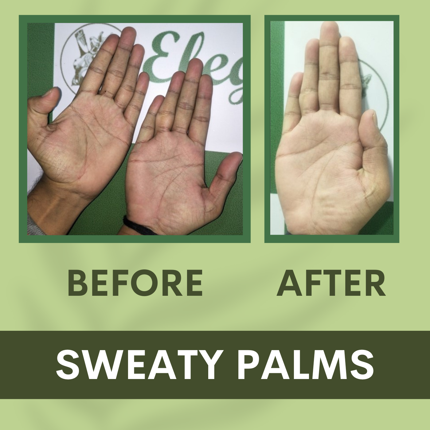 Sweaty Palms Correction, Botox and Filler Treatments Clinic Surat, Gujarat, Mumbai, Pune Maharashtra episode artwork