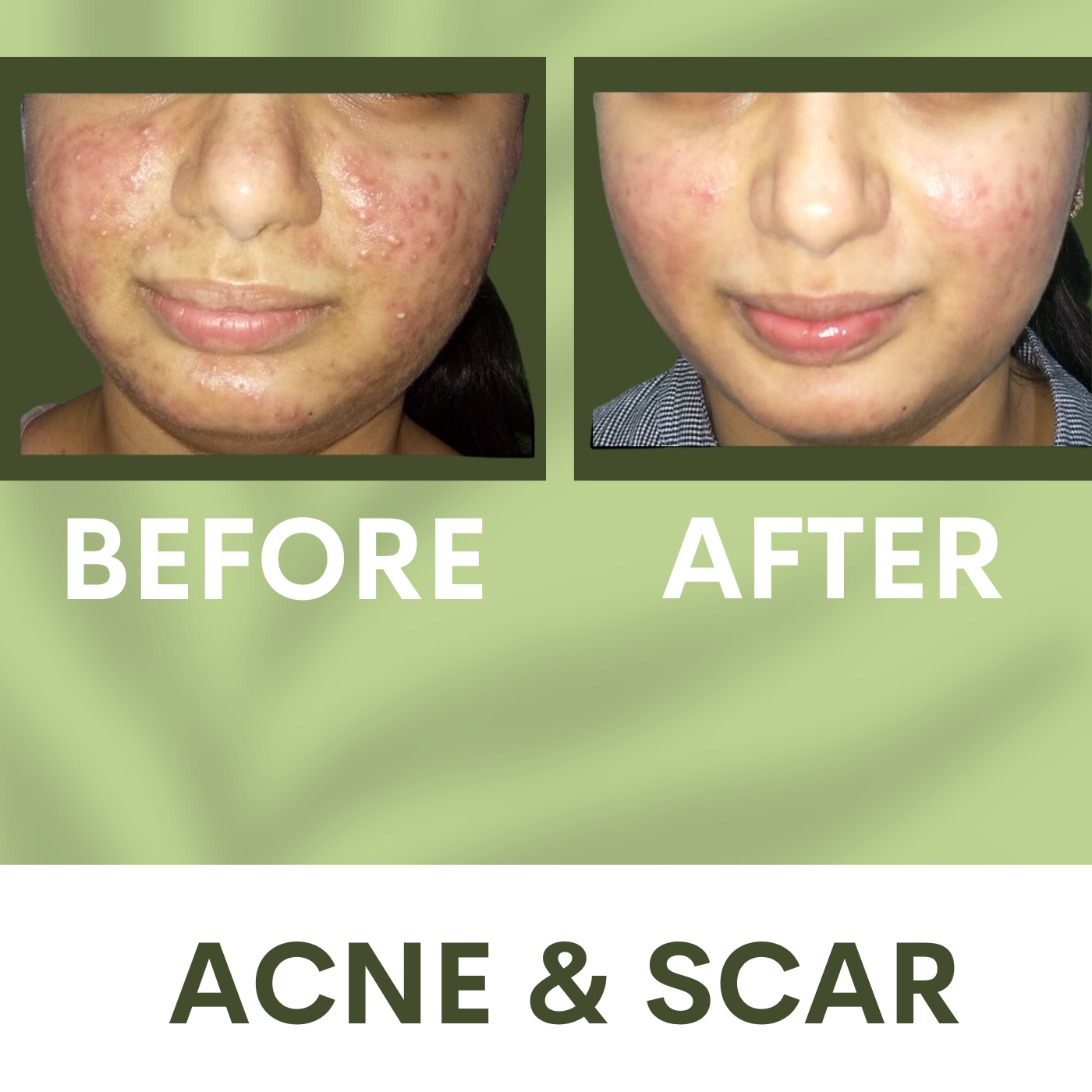 Acne Scar Correction | Acne Scar Removal with HA Filler Surat Gujarat, Mumbai Maharashtra, Rajasthan episode artwork