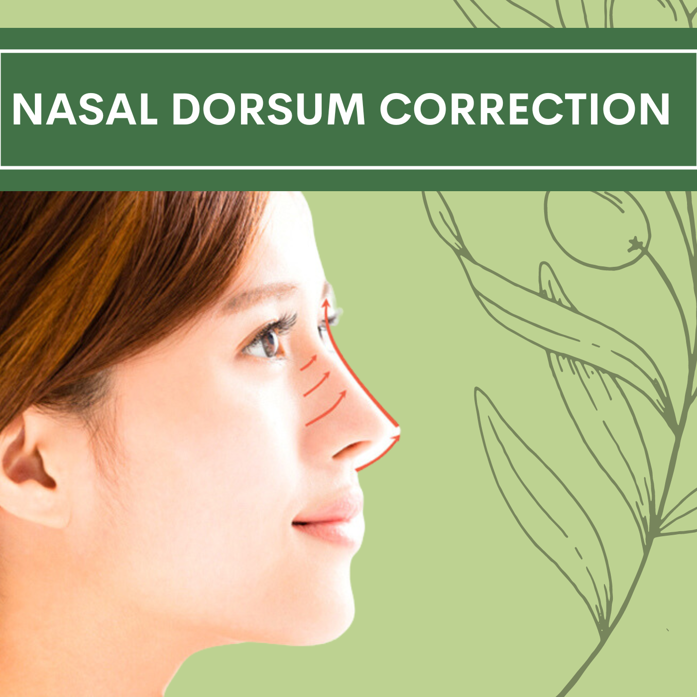 Nasal Dorsum Correction, pal, adajan, vesu, piplod, athwagate,bhatar, olpad, elegance clinic episode artwork