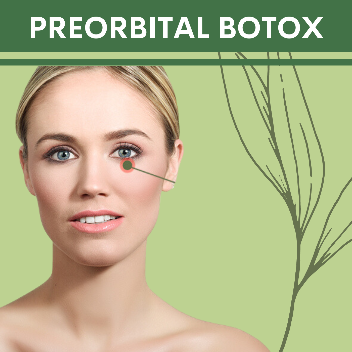 Periorbital Botox, pal, adajan, vesu, piplod, athwagate,bhatar, olpad, elegance clinic episode artwork