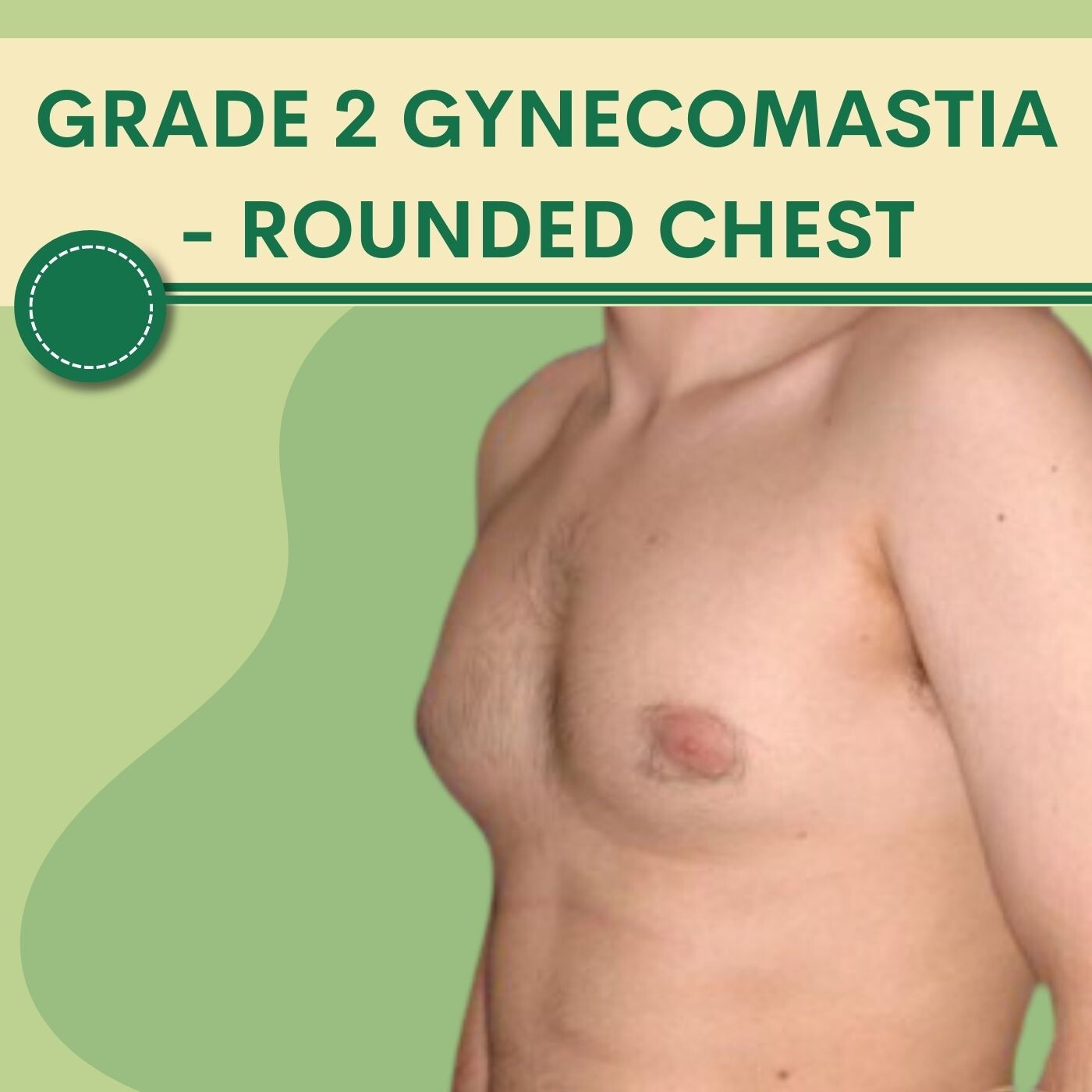 Rounded Chest,about gynecomastia, glands and fats, scareless surgery pal, adajan, vesu, piplod, athwagate,bhatar, olpad, elegance clinic episode artwork