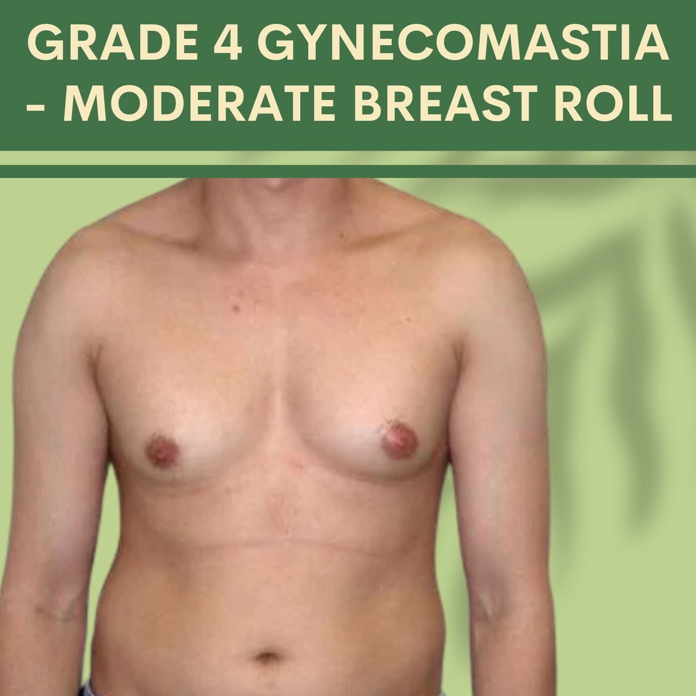 Moderate Breast Roll, under nipple fat, suction surgery, pal, adajan, vesu, piplod, athwagate,bhatar, olpad, elegance clinic episode artwork