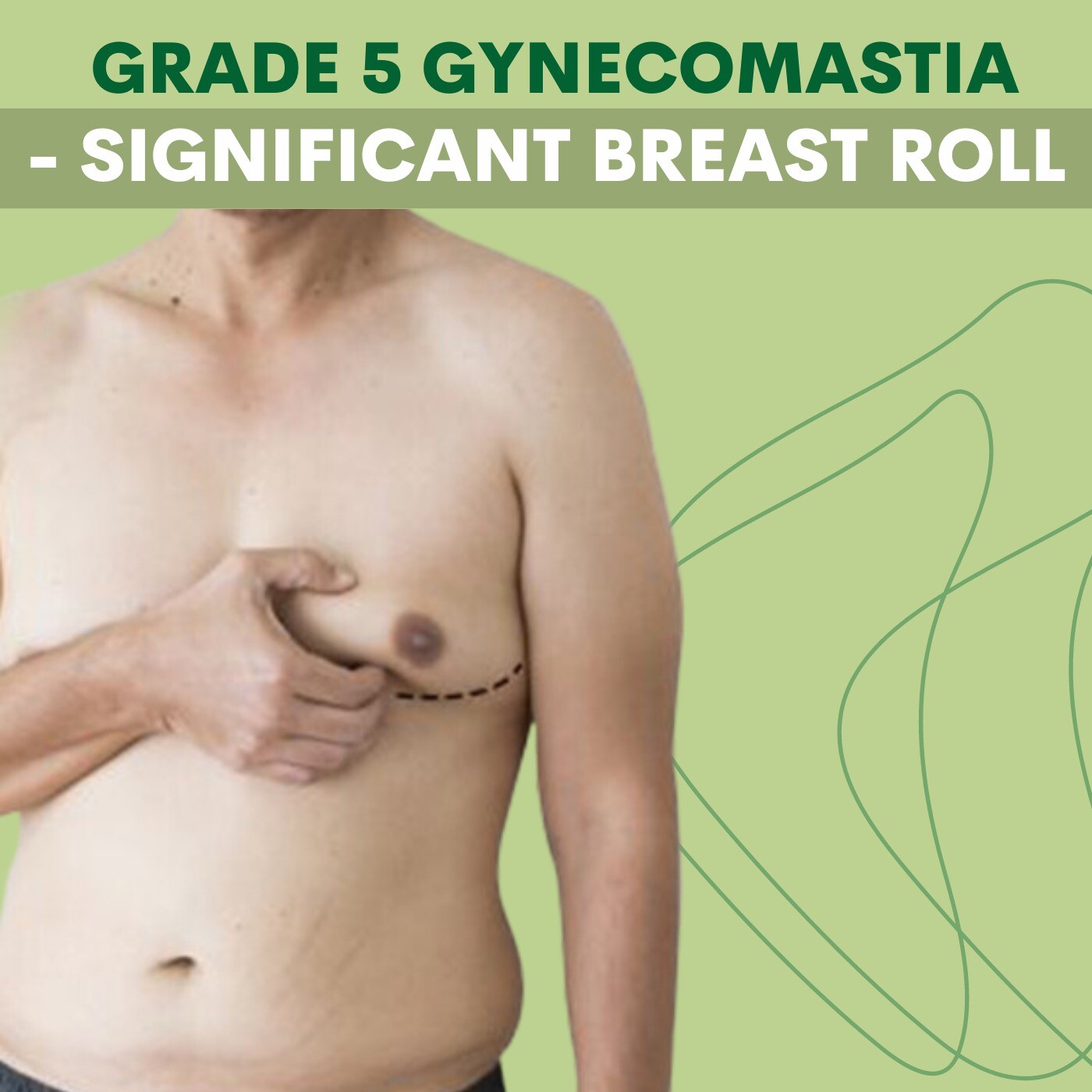 Significant breast roll, suction surgery, sagging chest part, pal, adajan, vesu, piplod, athwagate,bhatar, olpad, elegance clinic episode artwork