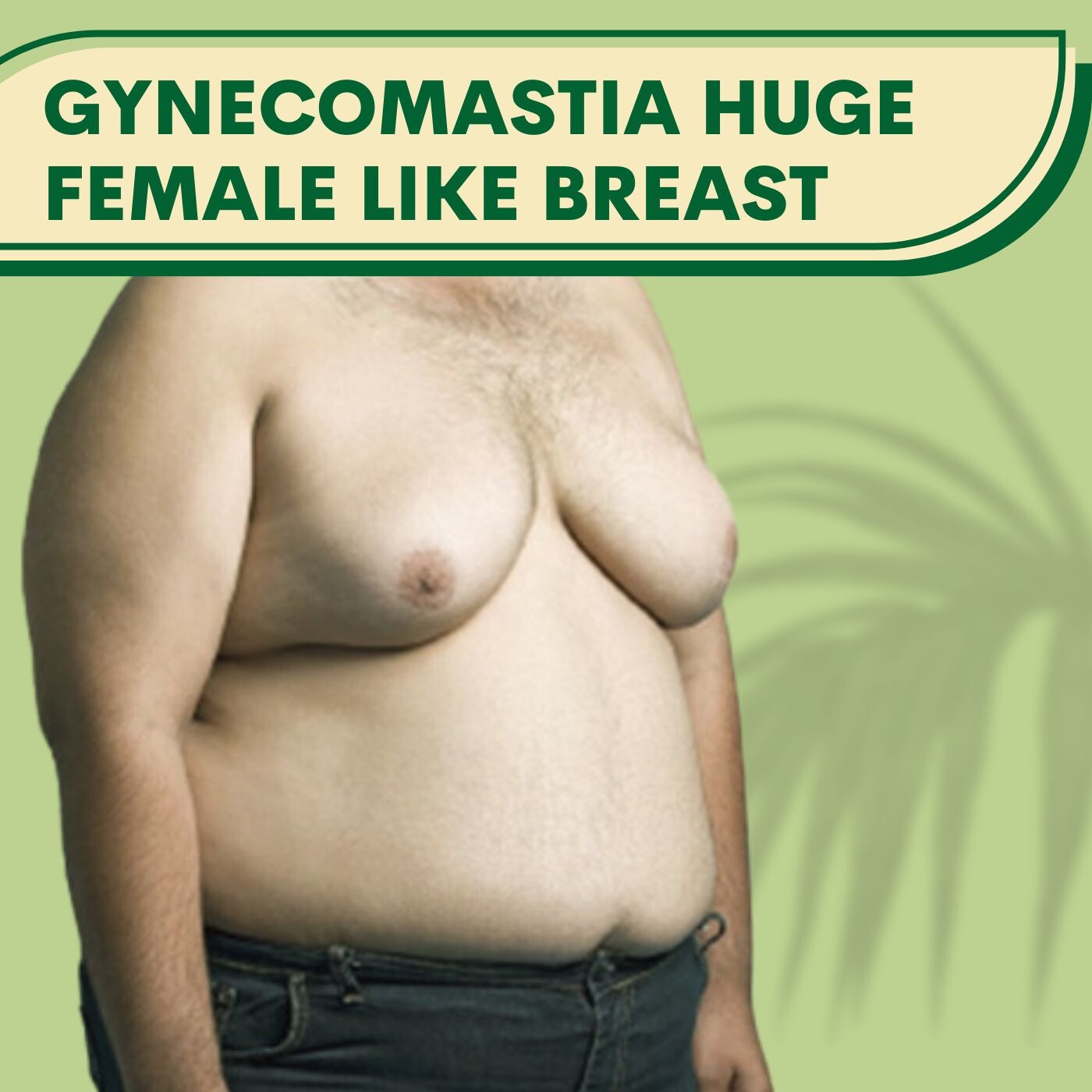 Huge breast, extra skin exceeding surgey,lipo suction pal, adajan, vesu, piplod, athwagate,bhatar, olpad, elegance clinic episode artwork