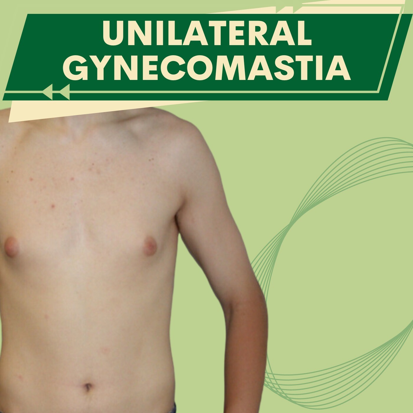 Unilateral, Single Gynecomastia, Scareless Surgery, Pal Gam, Adajan, Laldarwaja, Piplod, Surat episode artwork