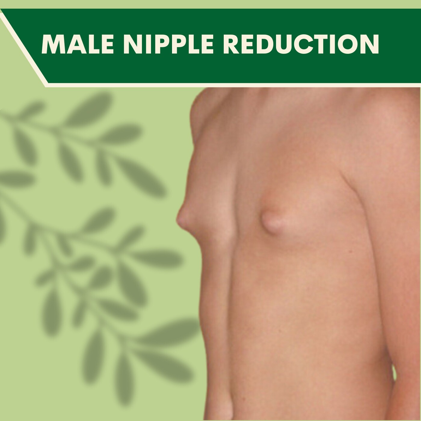 Male nipple reduction, gland removing, scareless, vesu, bhatar, ghoddhod, majura, surat, gujarat. episode artwork