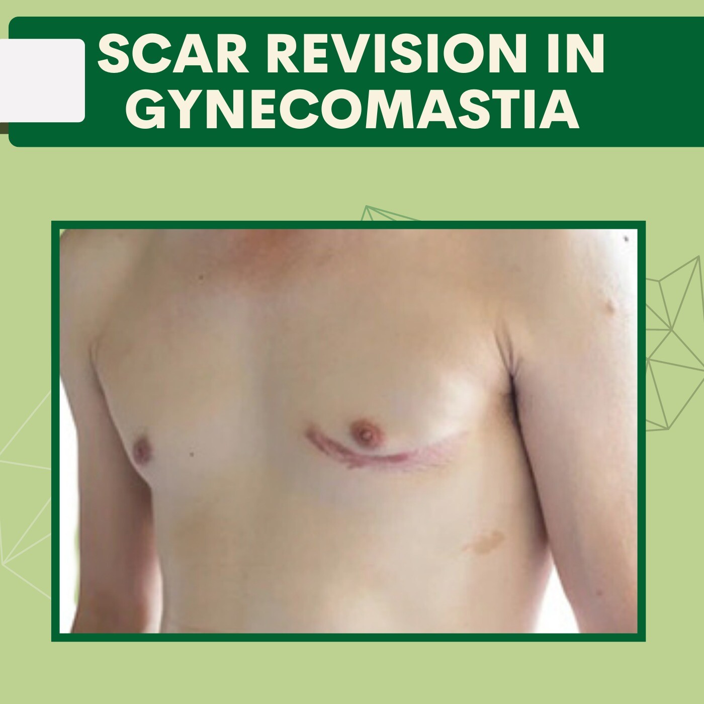 Scar revision gynecomastia, surgery removal, pal, palanpor, rander, adajan, surat, gujarat. episode artwork