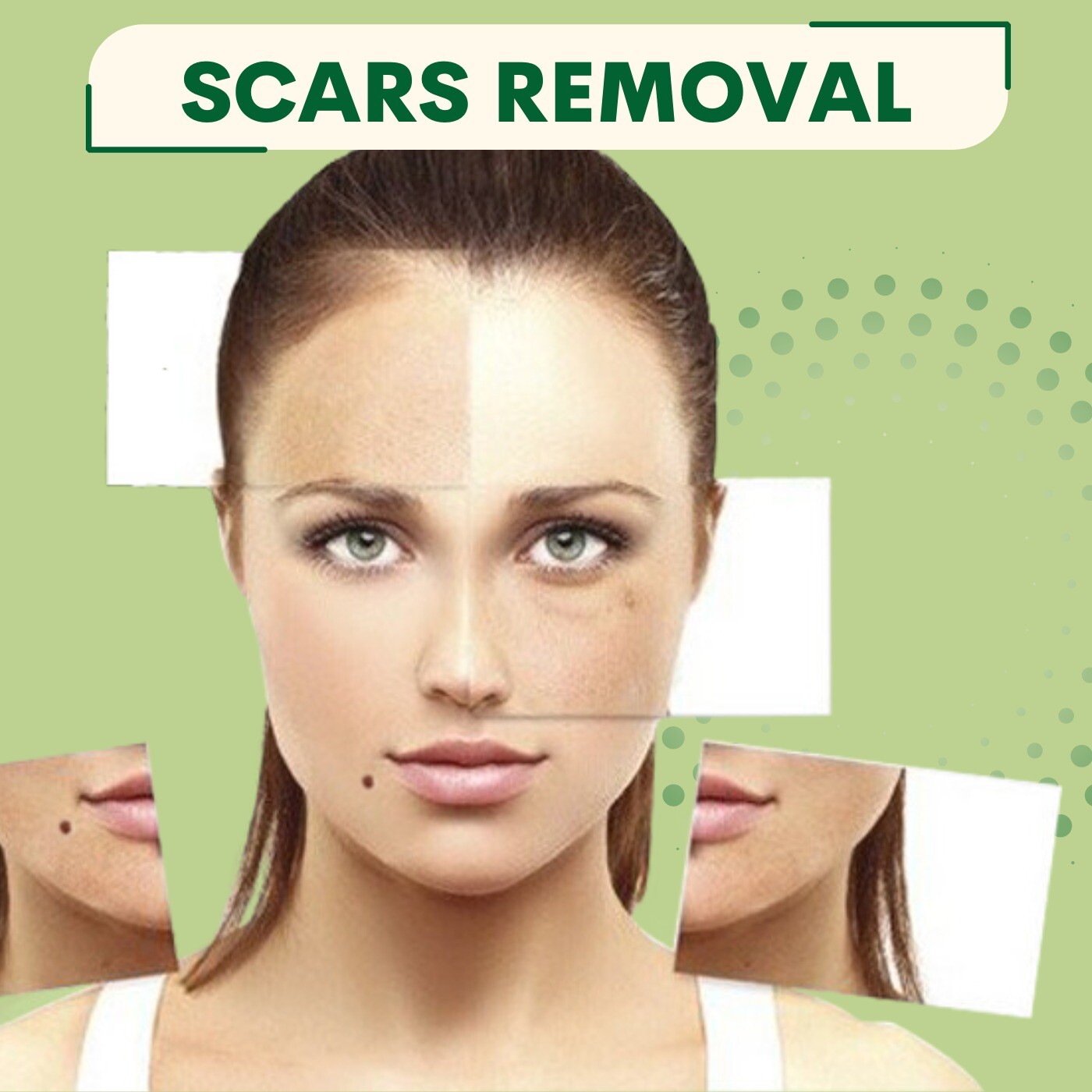 Scar Removal, Scar Revision, Replacement By Skin, Nanpura, Gopipura, Bharuch, Surat, Gujarat. episode artwork