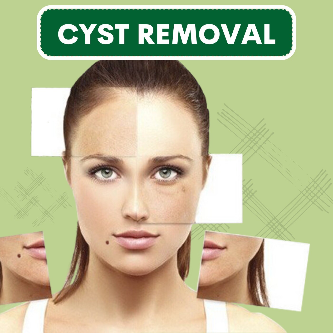 Cyst Removal, Cyst Under Ear, Near Eyelid Cyst, Daycare Surgery, Narmada, Navsari, Olpad, Surat, Gujarat. episode artwork