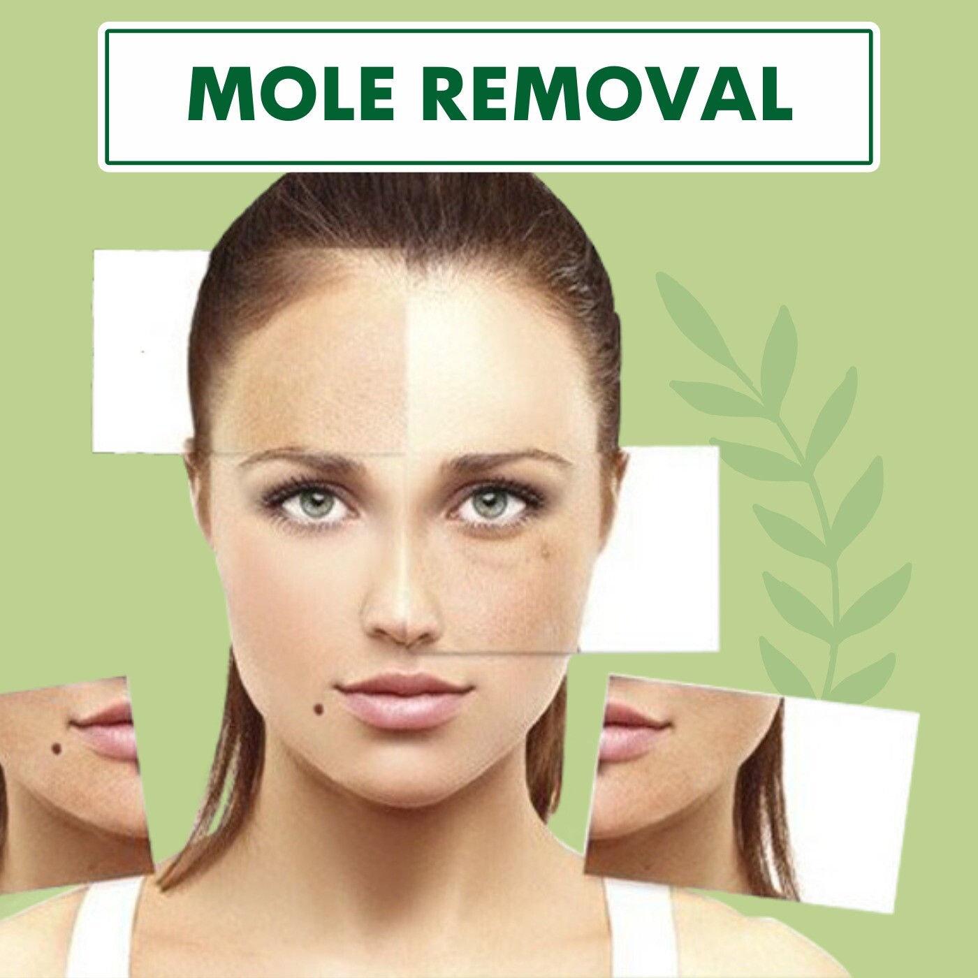 Mole Removal, Black Pigmentation, Mole Creation , Pal, Adajan, Palanpor, Surat, Gujarat. episode artwork