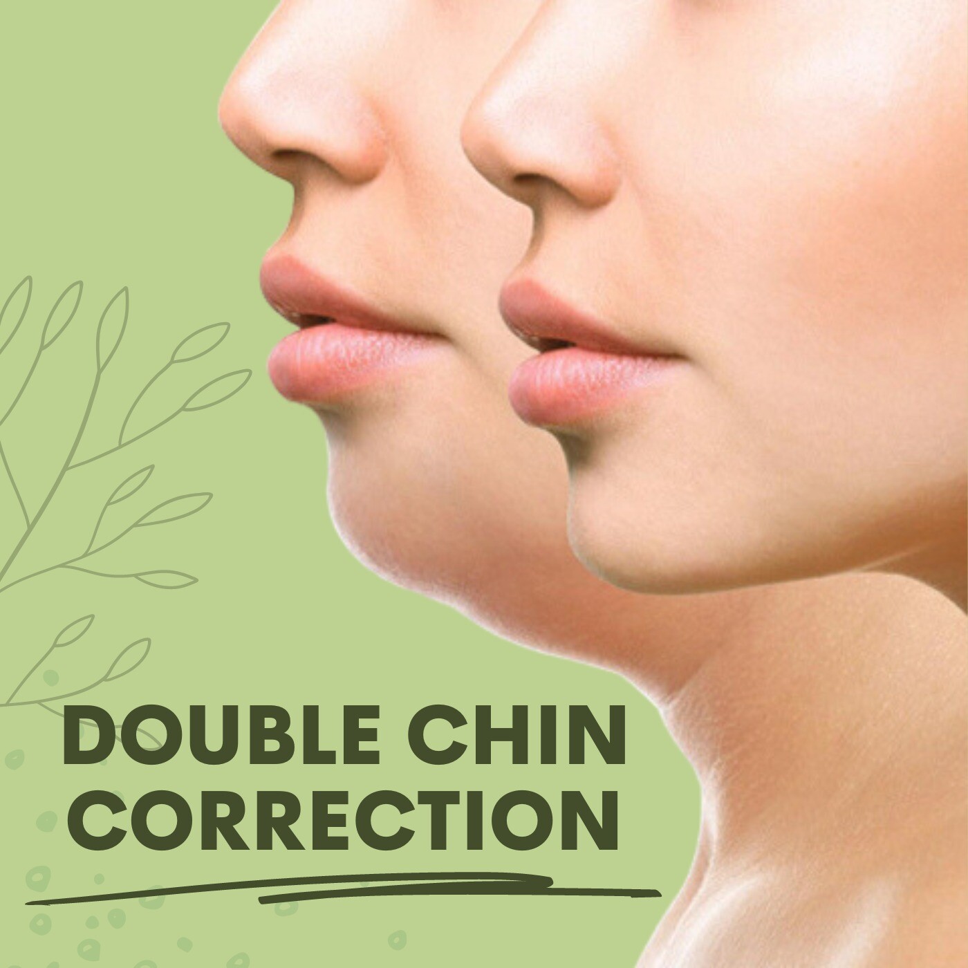 Double Chin, Fat Dissolving Surgery, Thread Lifting, Dang, Navsari, Surat, Gujarat.