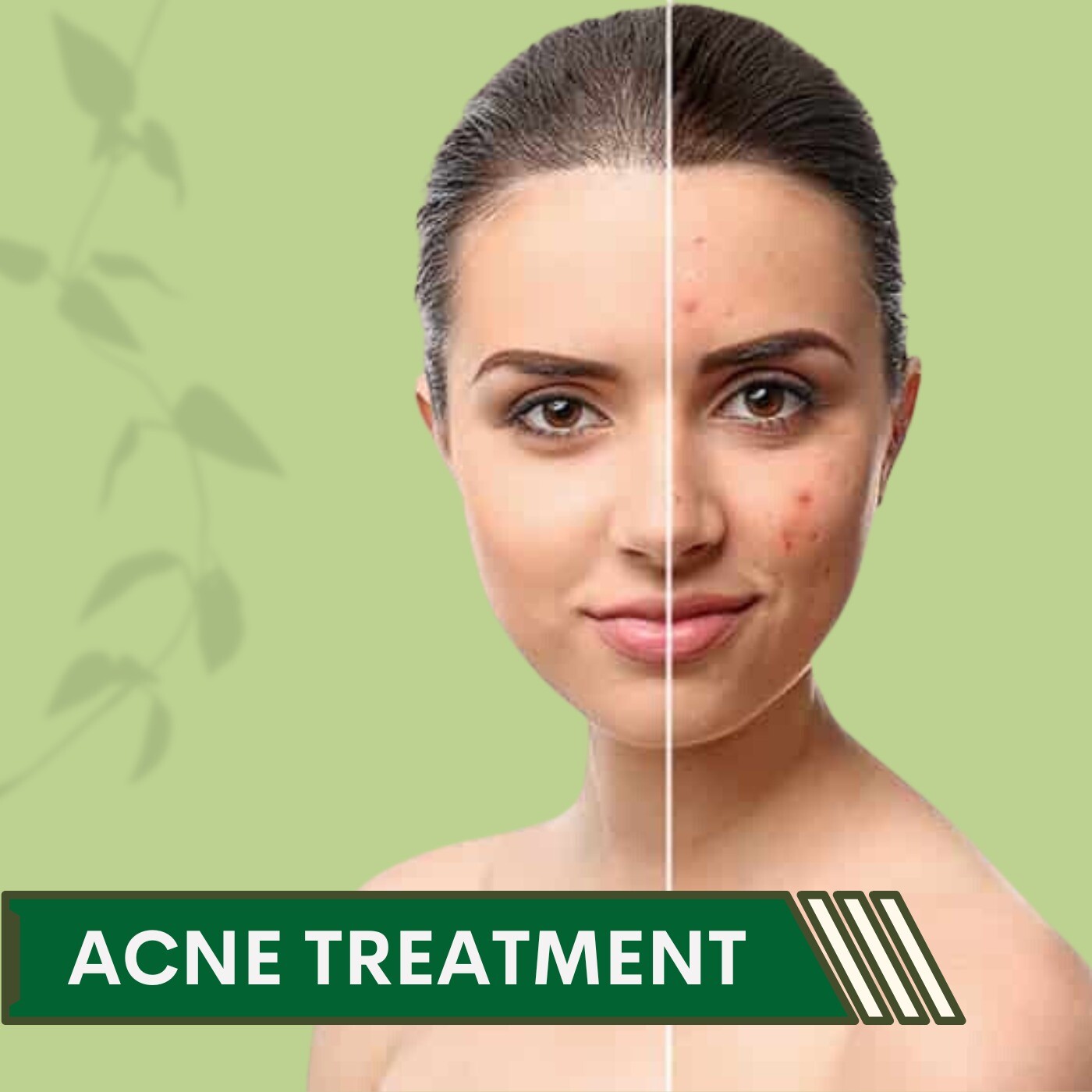 Acne treatment, Hormonal Imbalance, Radio Frequency, Majuragate, Athwa, Piplod, Surat, Gujarat. episode artwork