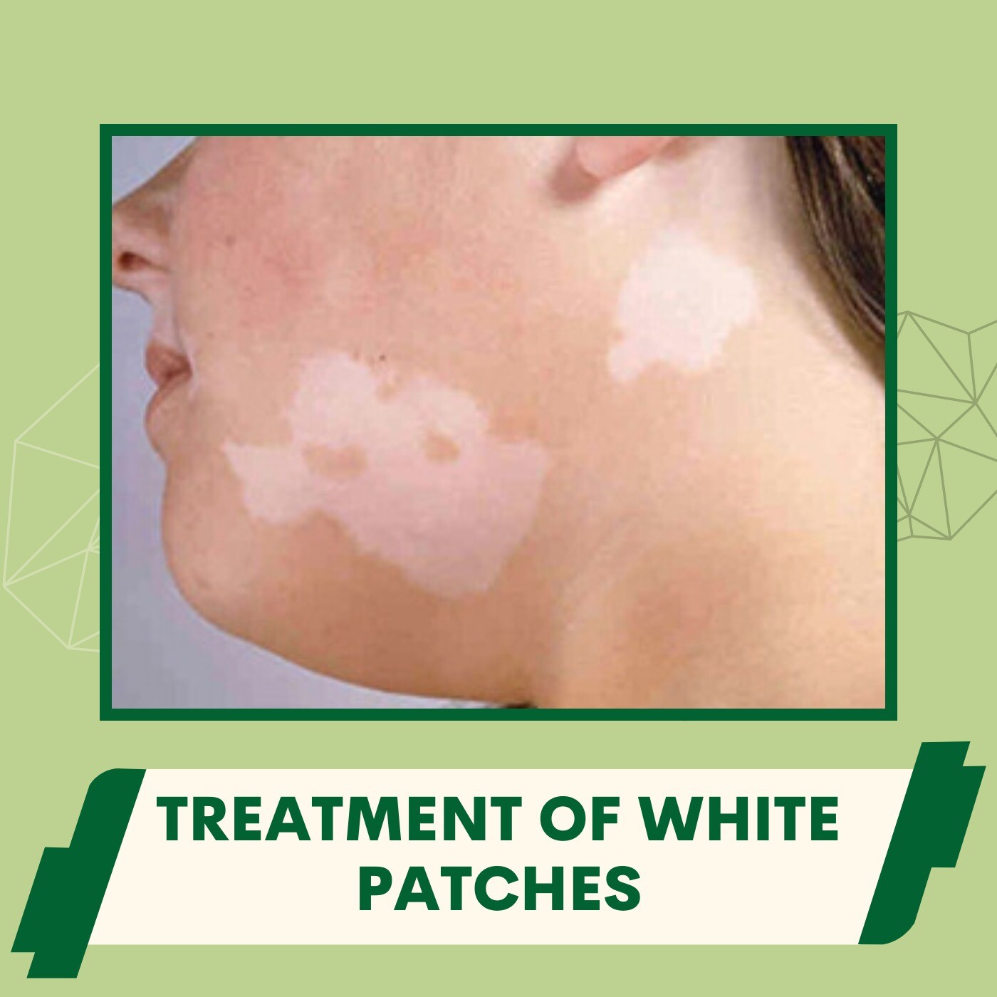 Treatment Of White Patches, Vitiligo, Melanogenesis, Katargam, Rander, Bhatar, Surat, Gujarat. episode artwork