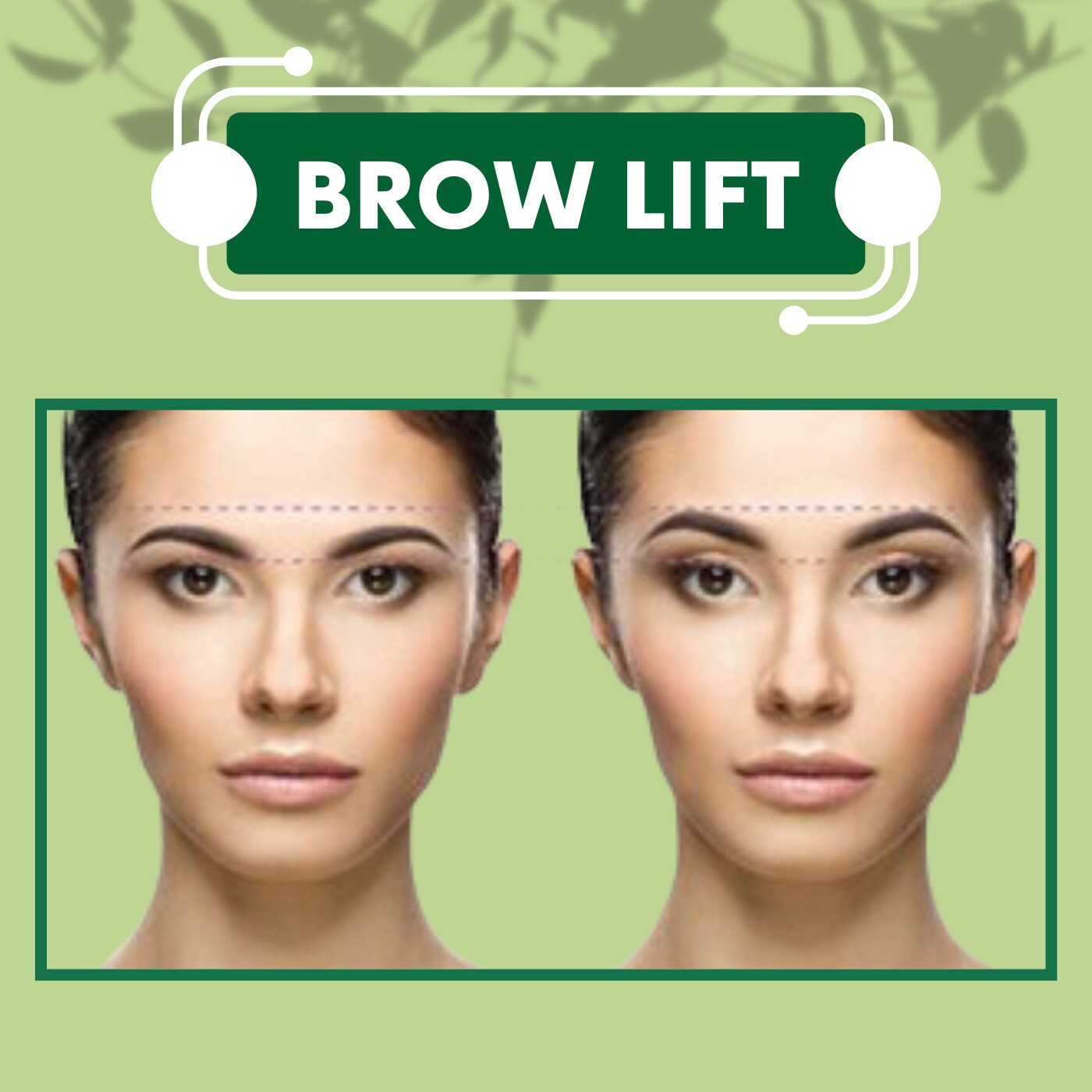 Brow Lift, Tread Lift Process, Botox, Filler, Ghoddhod, Piplod, Citylight, Surat, Gujarat. episode artwork