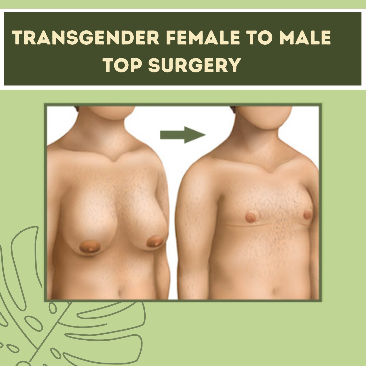 Transgender Female To Male Top Surgery, Mastectomy Surgery, Gynecomastia Surgery, Surat, Anand, Gujarat, Udaipur, India.