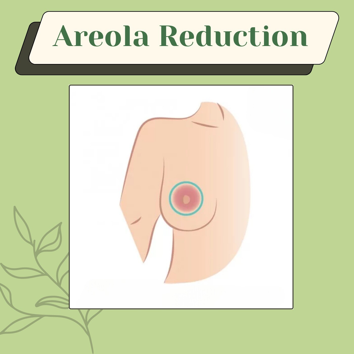 Areola Reduction, Breast Surgery, Recovery, Cost Ujjain, Udaipur, Mumbai, Surat. episode artwork