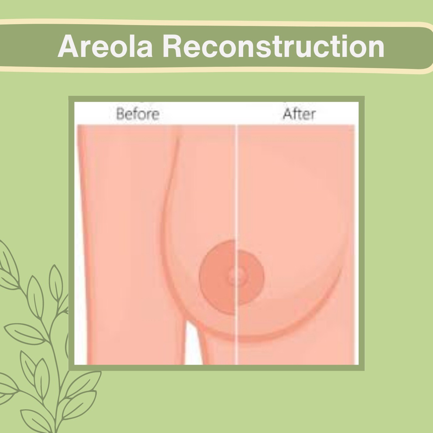 Areola Reconstruction, Retro-Auricular Skin, Areola Tattooing, Athwa, Umra, Majura, Nana Varachha, Surat, Gujarat. episode artwork