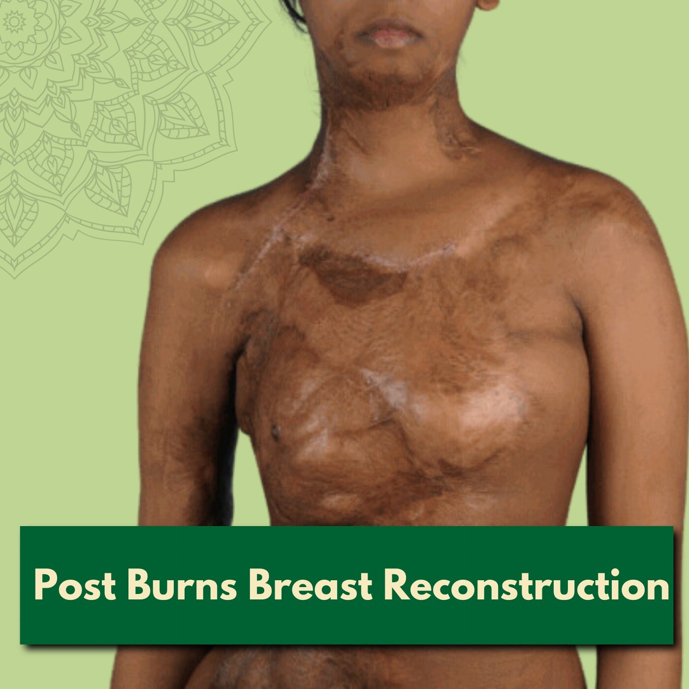 Post Burns Breast Reconstruction, Release And Skin Grafts, Areola Reconstruction Surgery, Adajan, Laldarwaja, Nanpura, Katargam, Surat, Gujarat. episode artwork