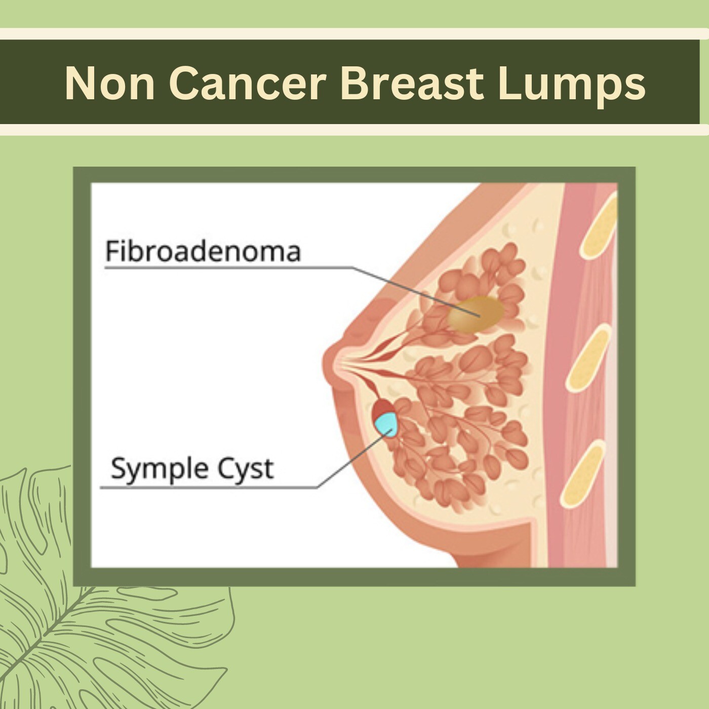 Non Cancer Breast Lumps, Remove Scar tissues, Periareolar And Inframammary Treatment, Nanpura, Gopipura, Athwa, Rander, Surat, Gujarat. episode artwork