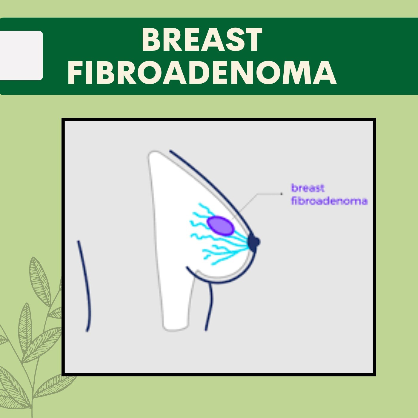 Breast Fibroadenoma, Periareolar Treatment, non-cancerous breast tumor, Mumbai, Udaipur, Surat, India.